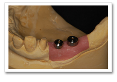インプラント治療の流れ-人工の歯をつける準備